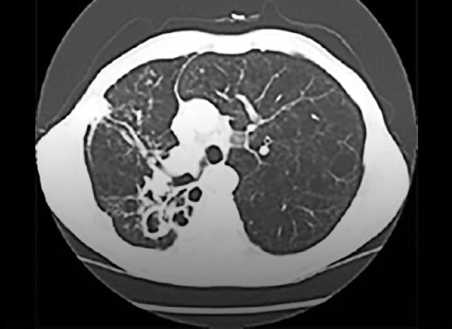 Fibrocavitary patient progression scan