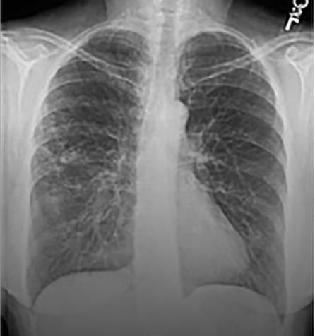 Nodular bronchiectatic patient progression scan