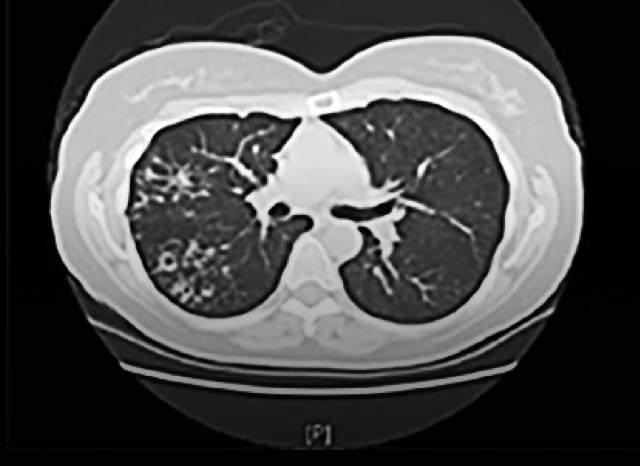 Fibrocavitary patient progression scan